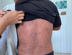 Prevalensi Kusta Sulbar Masih Tinggi, 230 Kasus Aktif Tersebar di Enam Kabupaten